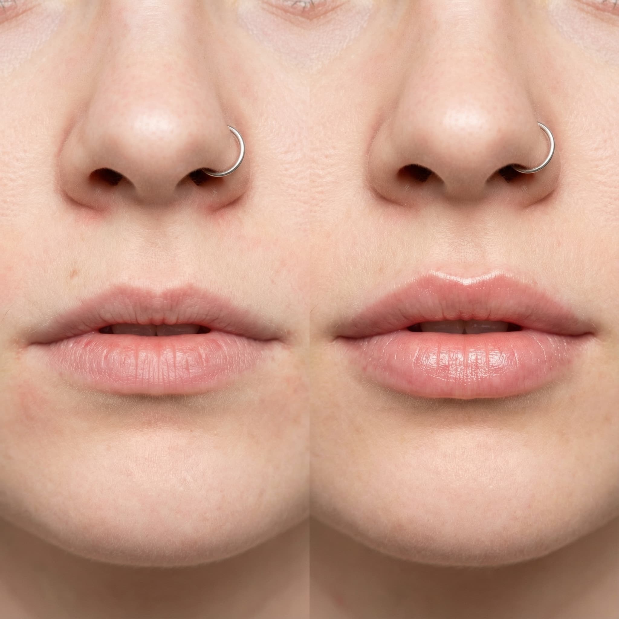 Lip Filler Before & After Comparison